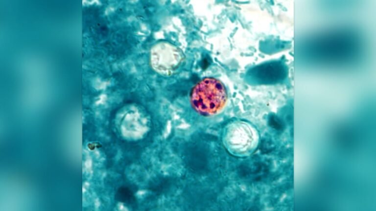 CDC warns of rising parasite infections with a horrifying symptom: 2026 cyclosporiasis outbreak spreads